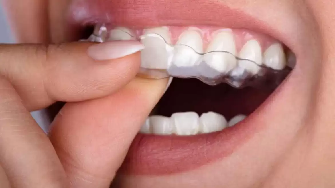 Should I Treat My Misaligned Teeth?