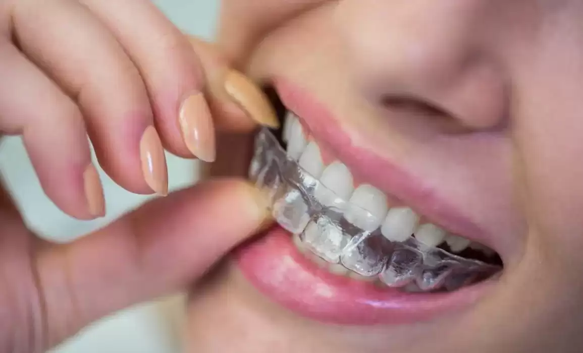 How to Keep Your Invisible Braces Looking Good As New