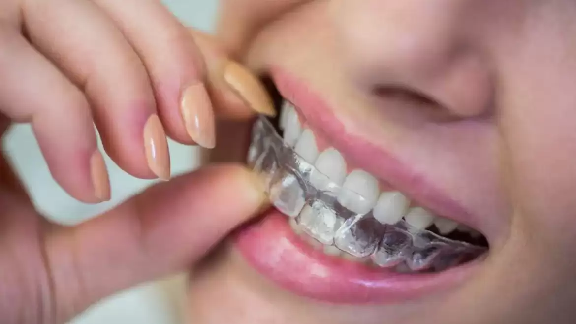 How to Keep Your Invisible Braces Looking Good As New