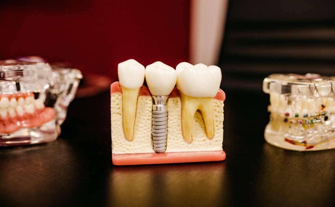 Osseointegration – What is it & How Does it Influence the Success of Dental Implants