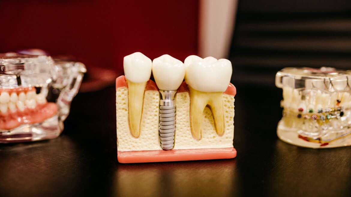 Osseointegration – What is it & How Does it Influence the Success of Dental Implants