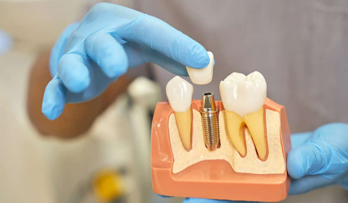 Osseointegration: The Key to Successful Dental Implant Surgery