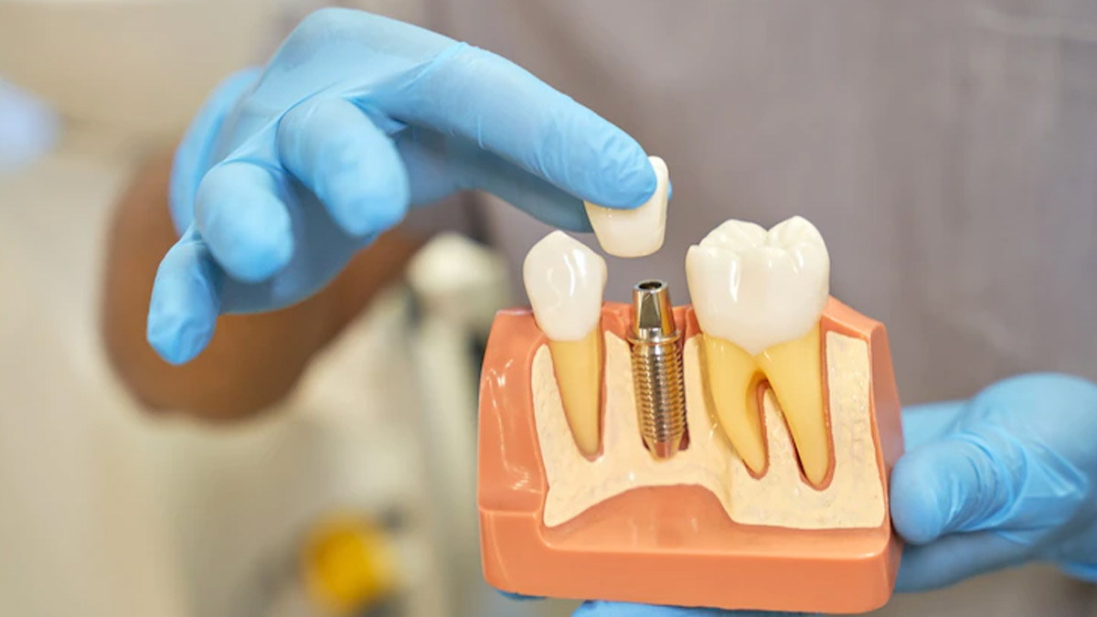 Dental implants near me-no gap dentists-melbourne