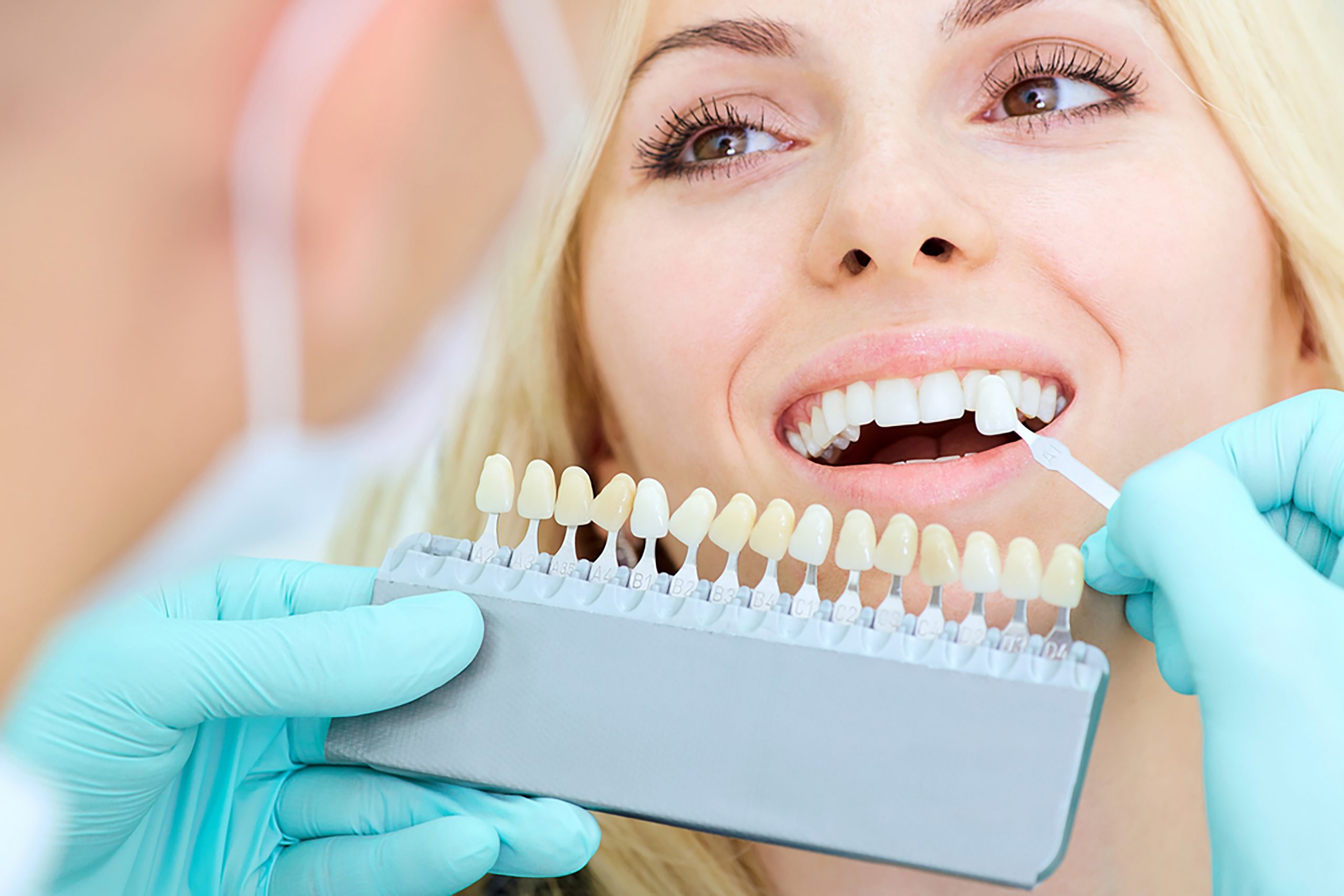 teeth whitening Melbourne-no gap dentists-melbourne