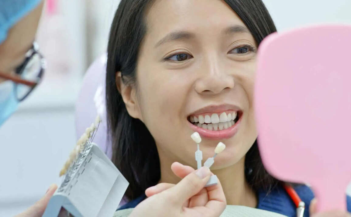 Teeth Whitening After Dental Implants – 5 Things You Need to Know