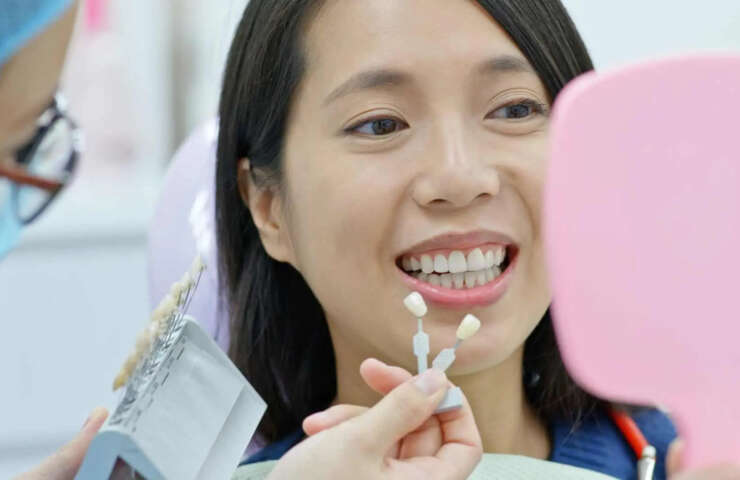 Teeth Whitening After Dental Implants – 5 Things You Need to Know