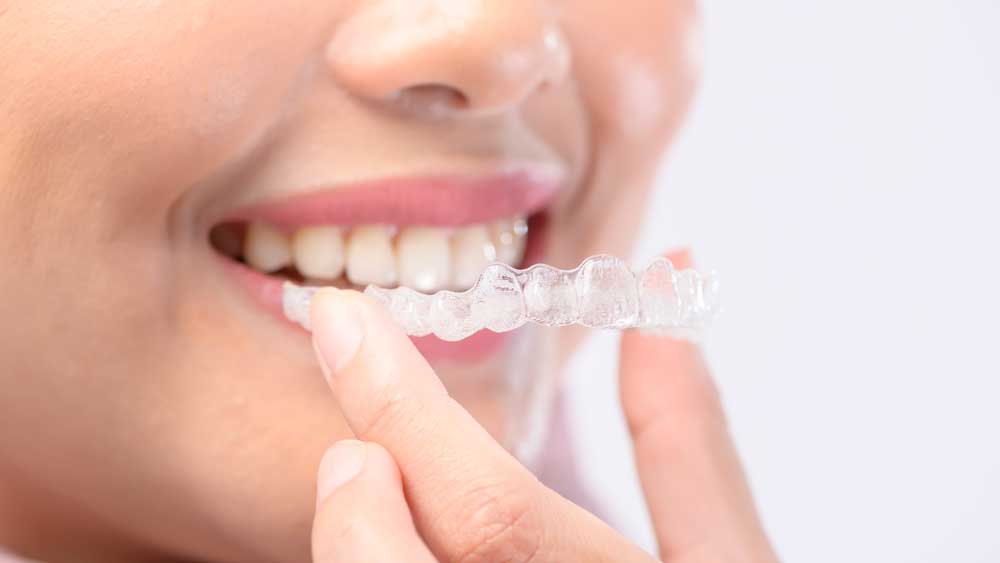 Invisible Braces for Adults: What to Expect When Straightening Teeth After 40