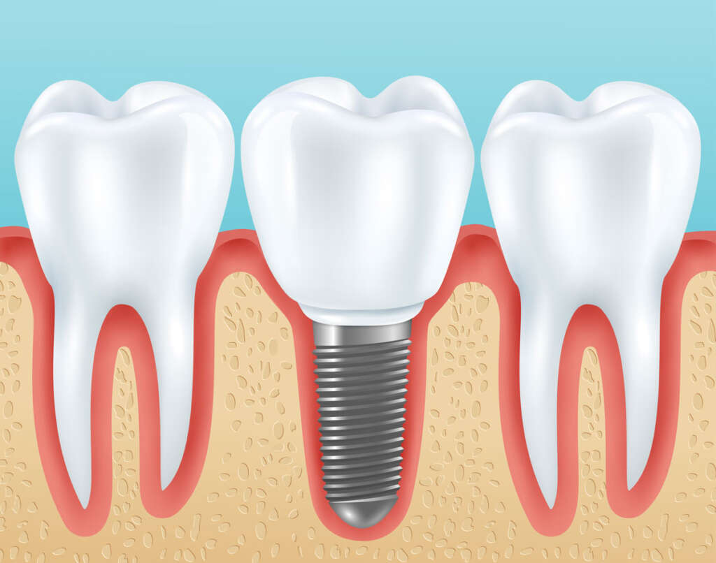 Dental implant model showing titanium post, abutment, and artificial crown replacement