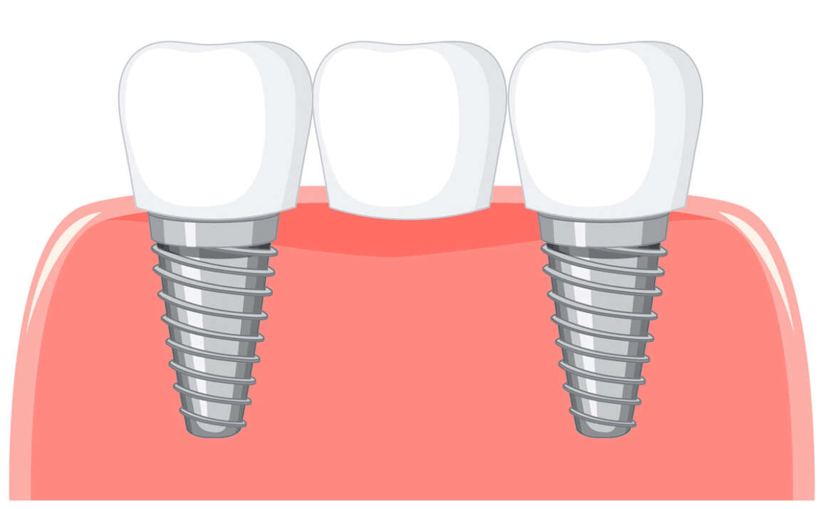 Zirconia vs. Titanium: Choosing the Best Biocompatible Material for Your Dental Bridge