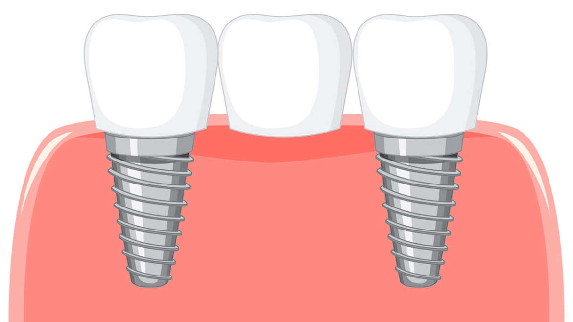 Zirconia vs. Titanium: Choosing the Best Biocompatible Material for Your Dental Bridge