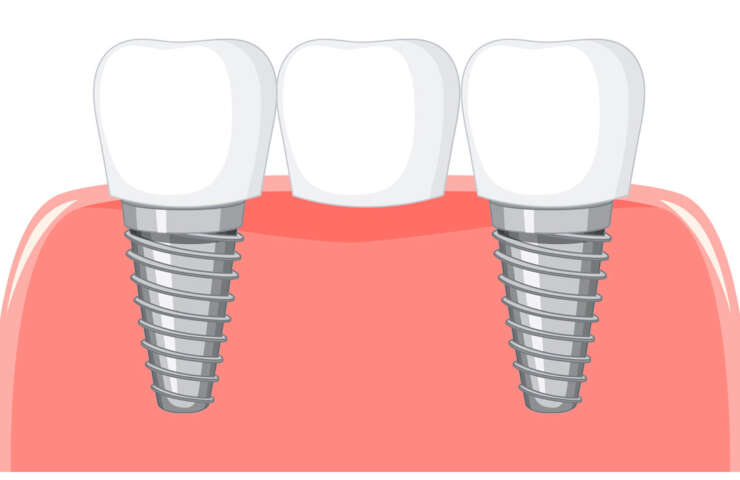 Zirconia vs. Titanium: Choosing the Best Biocompatible Material for Your Dental Bridge