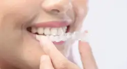Can You Get Invisible braces on Medicare? What Aussie Patients Need to Know