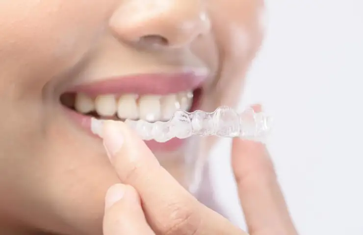 Can You Get Invisible braces on Medicare? What Aussie Patients Need to Know