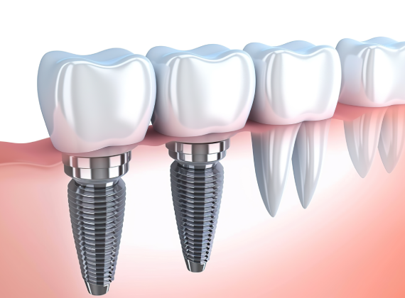 Illustration of two titanium dental implants with white crowns in the jawline from Affordable Dentist Melbourne